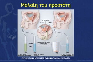 Μάλαξη του προστάτη
ΕΞΕΤΑΣΗ ΤΩΝ 4 ΔΕΙΓΜΑΤΩΝ ΟΥΡΩΝ ΚΑΤΑ MEARES-STAMEY
 