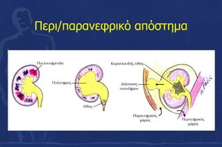 Περι/παρανεφρικό απόστημα
 