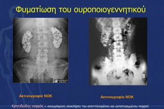 Φυματίωση του ουροποιογεννητικού
Aκτινογραφία ΝΟΚ
Κρητιδώδης νεφρός = σκιαγράφηση ολοκλήρου του αποτιτανωμένου και κατεστραμμένου νεφρού
Aκτινογραφία ΝΟΚ
 