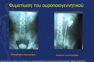 Φυματίωση του ουροποιογεννητικού
Ενδοφλέβια ουρογραφία Ανιούσα πυελογραφία
Στενώματα των αυχένων των καλύκων της πυελοουρητηρικής και κυστεοουρητηρικής συμβολής - δίκην μαργαρίτα
 