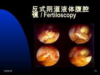 02/02/18 13
反式阴道液体腹腔
镜 / Fertiloscopy
 Details about this topic
 Supporting information and
examples
 How it relates to your audience
 