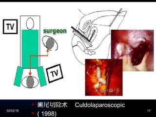 02/02/18 17
 尾切除阑 术 Culdolaparoscopic
 ( 1998)
Real Life
 Give an example or real life
anecdote
 Sympathize with the audience’s
situation if appropriate
阑阑尾切除 尾切除阑 术
术尾切阑尾切除术除术
)
 