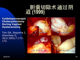 02/02/18 19
胆囊切除 通术 过阴
道 (1999)
Culdolaparoscopic
Cholecystectomy
During Vaginal
Hysterectomy.
Tsin DA, Sequeira J,
Giannikas G.
JSLS 2003;7:171-
172.
 