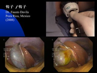 02/02/18 33
Dr. Fausto Davila
Poza Rica, Mexico
(2008)
子钩 / 子钩
 