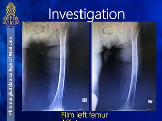 PhramongkutklaoCollegeofMedicine
Film left femur
Investigation
 