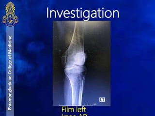 PhramongkutklaoCollegeofMedicine
Film left
Investigation
 