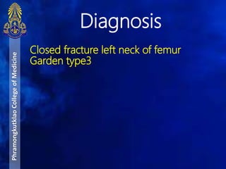 Closed fracture left neck of femur
Garden type3
Diagnosis
PhramongkutklaoCollegeofMedicine
 