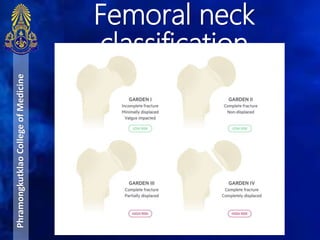Femoral neck
classification
PhramongkutklaoCollegeofMedicine
 