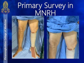Primary Survey in
MNRH
PhramongkutklaoCollegeofMedicine
 
