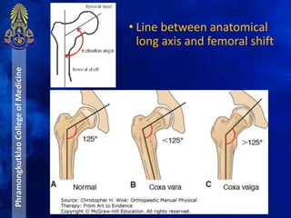 PhramongkutklaoCollegeofMedicine
• Line between anatomical
long axis and femoral shift
 