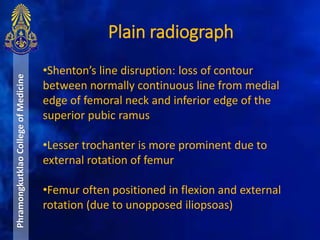 Plain radiograph
PhramongkutklaoCollegeofMedicine
•Shenton’s line disruption: loss of contour
between normally continuous line from medial
edge of femoral neck and inferior edge of the
superior pubic ramus
•Lesser trochanter is more prominent due to
external rotation of femur
•Femur often positioned in flexion and external
rotation (due to unopposed iliopsoas)
 