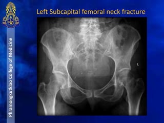 PhramongkutklaoCollegeofMedicine Left Subcapital femoral neck fracture
 