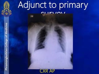 Adjunct to primary
survey
PhramongkutklaoCollegeofMedicine
CXR AP
 