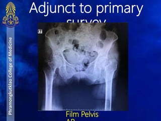 Adjunct to primary
survey
PhramongkutklaoCollegeofMedicine
Film Pelvis
 