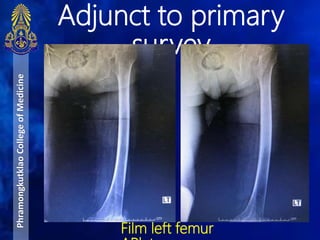 Adjunct to primary
survey
PhramongkutklaoCollegeofMedicine
Film left femur
 