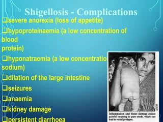Shigellosis - Complications
severe anorexia (loss of appetite)
hypoproteinaemia (a low concentration of
blood
protein)
hyponatraemia (a low concentration of blood
sodium)
dilation of the large intestine
seizures
anaemia
kidney damage
 