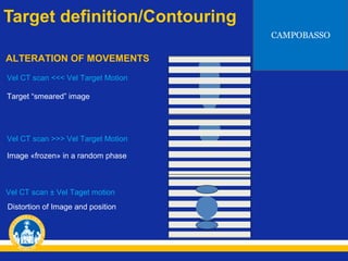 Target definition/Contouring
CAMPOBASSO

ALTERATION OF MOVEMENTS
Vel CT scan <<< Vel Target Motion
Target “smeared” image

Vel CT scan >>> Vel Target Motion
Image «frozen» in a random phase

Vel CT scan ± Vel Taget motion
Distortion of Image and position

 