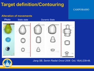 Target definition/Contouring
CAMPOBASSO

Alteration of movements
Photo

Static state

Dynamic State

Jiang SB, Semin Radiat Oncol 2006 Oct; 16(4):239-48.

 