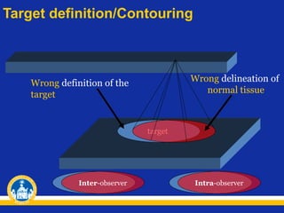 Target definition/Contouring

Wrong delineation of
normal tissue

Wrong definition of the
target

target

Inter-observer

Intra-observer

 