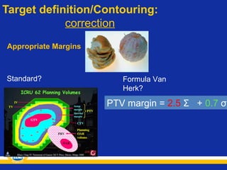 Target definition/Contouring:
correction
Appropriate Margins

Standard?

Formula Van
Herk?

PTV margin = 2.5 Σ + 0.7 σ

 