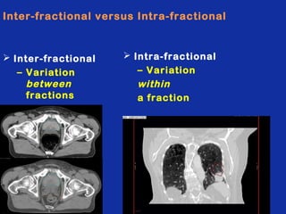 Inter-fractional versus Intra-fractional

 Inter-fractional
– Variation
between
fractions

47

 Intra-fractional
– Variation
within
a fraction

 