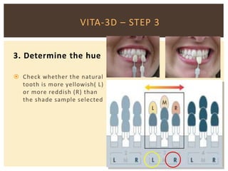 VITA-3D – STEP 3
3. Determine the hue
 Check whether the natural
tooth is more yellowish( L)
or more reddish (R) than
the shade sample selected
 