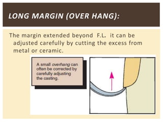 LONG MARGIN (OVER HANG):
The margin extended beyond F.L. it can be
adjusted carefully by cutting the excess from
metal or ceramic.
 