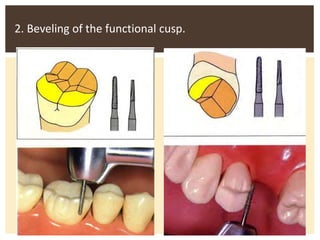2. Beveling of the functional cusp.
 