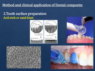 Method and clinical application of Dental composite
2.Tooth surface preparation
Acid etch or sand blast
 