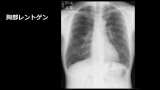 胸部レントゲン
 