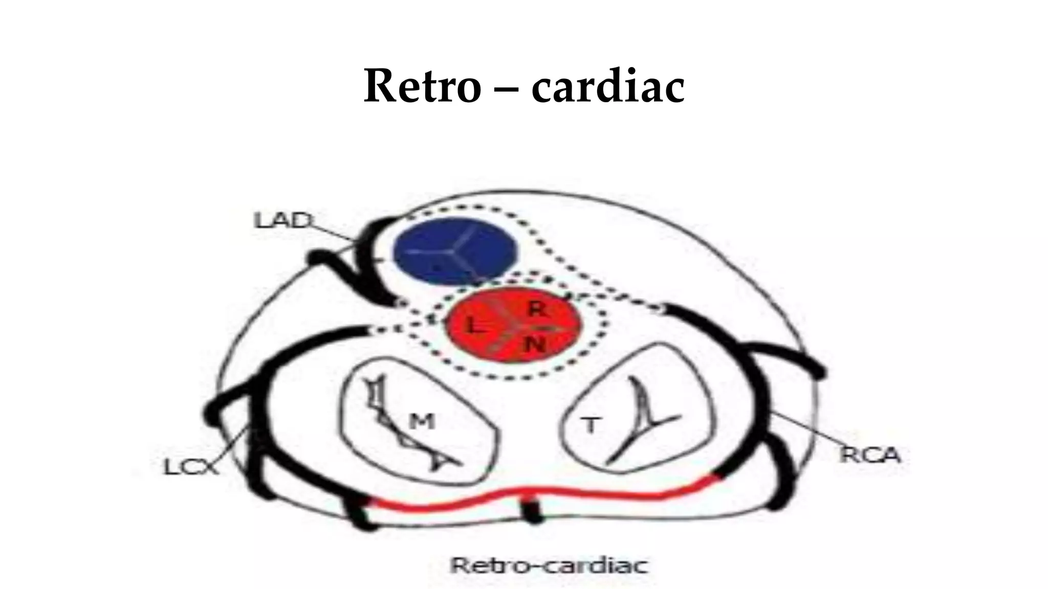 аномалие коронарных артерий - Anomaly coronary artery | PPT | Free Download