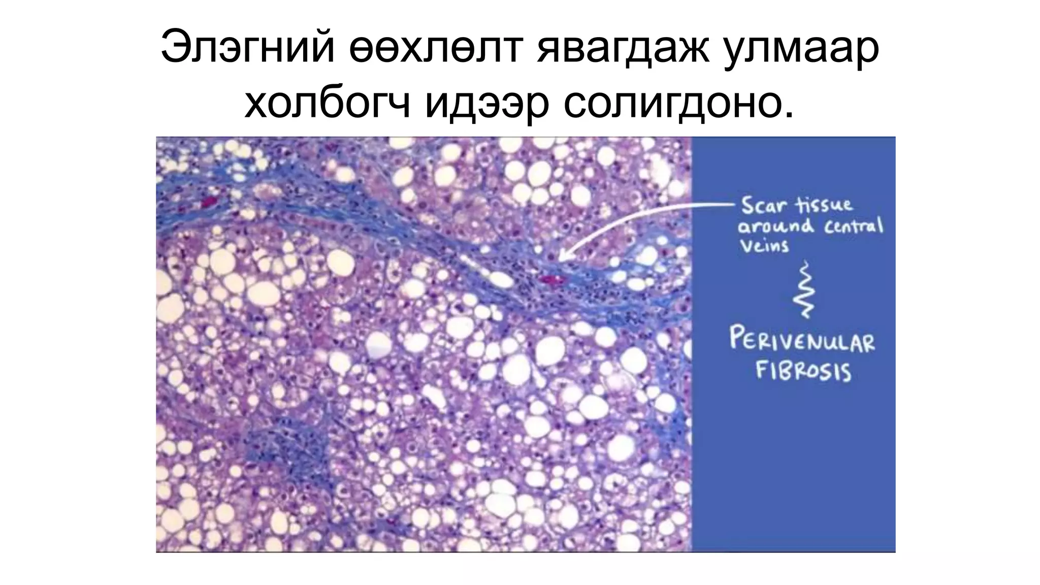 Элэгний өөхлөлт явагдаж улмаар
холбогч идээр солигдоно.
 