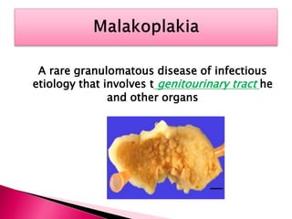 Malakoplakia PDF malakoplakia-pdf