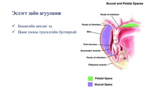 Эслэгт зайн агууламж
✓ Бишагийн өөхлөг эд
✓ Цөөн тооны тунгалгийн булчирхай
 