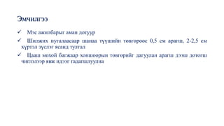 Эмчилгээ
✓ Мэс ажилбарыг аман дотуур
✓ Шилжих нугалаасаар шанаа түүшийн төвгөрөөс 0,5 см арагш, 2-2,5 см
хүртэл зүслэг ясанд тултал
✓ Цааш мохой багжаар хоншоорын төвгөрийг дагуулан арагш дээш дотогш
чиглэлээр явж идээг гадагшлуулна
 