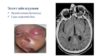 Эслэгт зайн агууламж
✓ Нүдний алимны булчингууд
✓ Судас мэдрэлийн багц
 