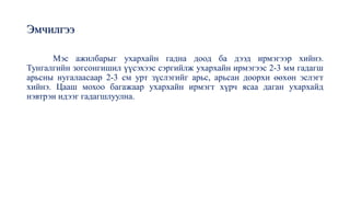 Эмчилгээ
Мэс ажилбарыг ухархайн гадна доод ба дээд ирмэгээр хийнэ.
Тунгалгийн зогсонгишил үүсэхээс сэргийлж ухархайн ирмэгээс 2-3 мм гадагш
арьсны нугалаасаар 2-3 см урт зүслэгийг арьс, арьсан доорхи өөхөн эслэгт
хийнэ. Цааш мохоо багажаар ухархайн ирмэгт хүрч ясаа даган ухархайд
нэвтрэн идээг гадагшлуулна.
 