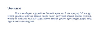 Эмчилгээ
Мэс ажилбарыг эрүүний их биений ирмэгээс 2 см доогуур 5-7 см урт
зүслэг арьсанд хийгээд арьсан доорх эслэг хүзүүний арьсан доорхи булчин,
өнгөц ба жинхэнэ хальсыг хурц мохоо замаар үечлэн зүсч эрүүн доорх зайд
хүрч идээг гадагшлуулна.
 