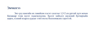 Эмчилгээ
Энэ үед хамгийн их төвийсөн хэсэгт салстыг 1,5-2 см урттай зүсч мохоо
багажаар тэлж идээг гадагшлуулна. Зүслэг хийхдээ шүлсний булчирхайн
цорго, хэлний мэдрэл судсыг гэмтээхээс болгоомжлох хэрэгтэй.
 