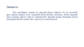 Эмчилгээ
Мэс ажилбарыг гаднаас нь эрүүний булан тойрсон 5-6 см зүслэгийг
арьс, арьсан доорхи эслэг, хүзүүний өнгөц булчин, хальсанд болон эрүүний
ясны салааны ирмэгт хүрч m. masseter-ийг эрүүний яснаас багажаар салган
зажлуурын булчин доорх зайд хүрч идээг гадагшлуулна.
 