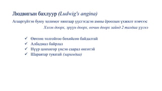 Людвигын бахлуур (Ludwig's angina)
Агааргүйтэн буюу холимог нянгаар үүсгэгдсэн амны ёроолын үхжилт нэвчээс
Хэлэн доорх, эрүүн доорх, оочин доорх зайнд 2 талдаа үүснэ
✓ Өвчтөн толгойгоо бөхийсөн байдалтай
✓ Албадмал байрлал
✓ Нүүр цонхигор үнсэн саарал өнгөтэй
✓ Шаравтар туяатай (заримдаа)
 