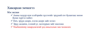 Хавсарсан эмчилгээ
Мэс заслын
✓ Амны гадуур нум хэлбэрийн зүслэгийг эрүүний нэг булангаас нөгөө
булан хүртэл хийнэ
✓ Ооч, эрүүн доорх, хэлэн доорх зайг нээнэ
✓ Эрүү далавчн, хэлний уг, залгиурын зайг шалгана
✓ Tracheostomy шаардлагатай үед амьсгалын зам чөлөөлөх
 