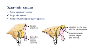Эслэгт зайн харьцаа
✓ Ясны хальсны үрэвсэл
✓ Ухархайн нэвчээс
✓ Хоншоорын хөндийн идээт үрэвсэл
 