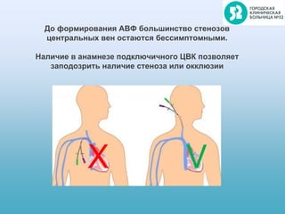 До формирования АВФ большинство стенозов
центральных вен остаются бессимптомными.
Наличие в анамнезе подключичного ЦВК позволяет
заподозрить наличие стеноза или окклюзии
Х V
 