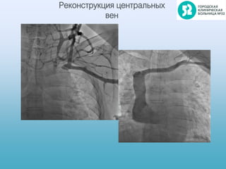 Реконструкция центральных
вен
 