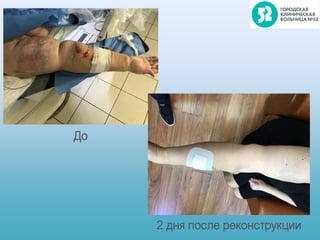 До
2 дня после реконструкции
 