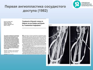 Первая ангиопластика сосудистого
доступа (1982)
 