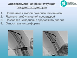 1. Применима к любой локализации стеноза.
2. Является амбулаторной процедурой
3. Позволяет немедленно продолжить диализ
4. Относительно комфортна
Эндоваскулярная реконструкция
сосудистого доступа
 