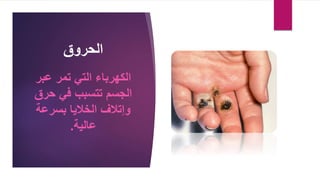 ‫الحروق‬
‫عبر‬ ‫تمر‬ ‫التي‬ ‫الكهرباء‬
‫الجسم‬
‫في‬ ‫تتسبب‬
‫حرق‬
‫بسرعة‬ ‫الخاليا‬ ‫وإتالف‬
‫عالية‬
.
 