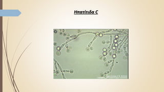 Ηπατίτιδα C
 